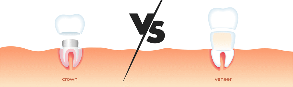 Difference Between Veneers and Crowns