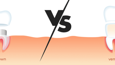 Difference Between Veneers and Crowns