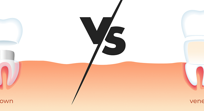 Difference Between Veneers and Crowns